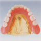 チタンIP加工義歯